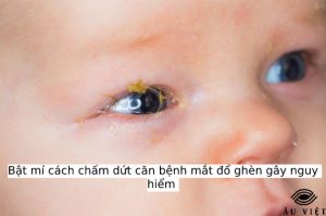 Bật mí cách chấm dứt căn bệnh mắt đổ ghèn gây nguy hiểm 