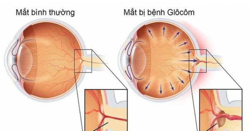 Bệnh Glaucoma góc đóng