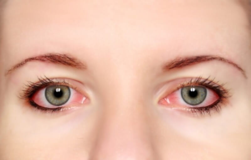 Bệnh đảo mắt liên tục tật rung lắc nhãn cầu sinh lý do tính mắc phải