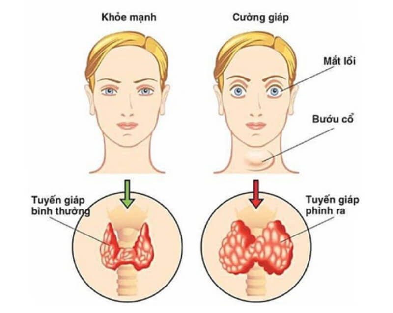 Bệnh mắt Basedow: Nguyên nhân, triệu chứng và cách điều trị