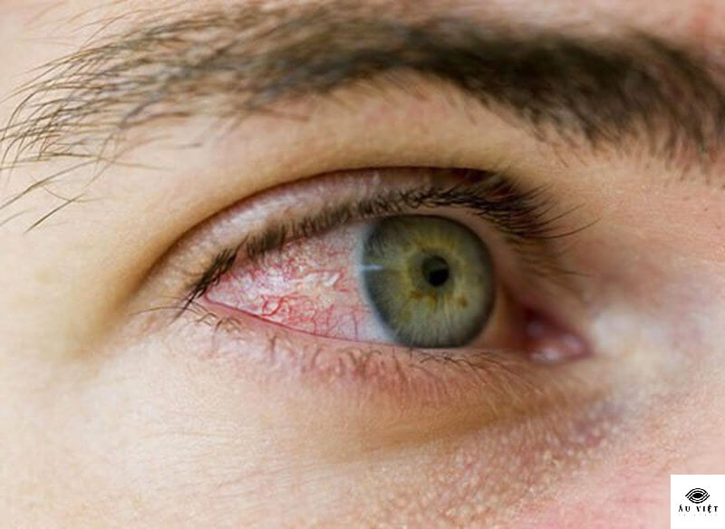 Bệnh mắt H10 là gì?