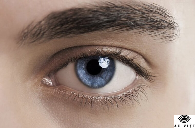 Bệnh mắt H52 là gì?