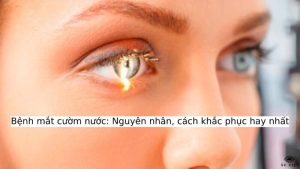 Bệnh mắt cườm nước: Nguyên nhân, cách khắc phục hay nhất