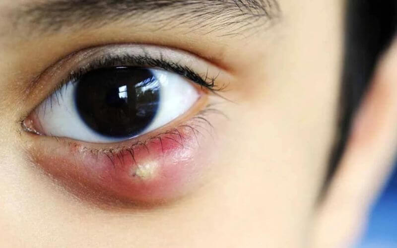 Bệnh mắt đổ ghèn có phải là triệu chứng của lẹo