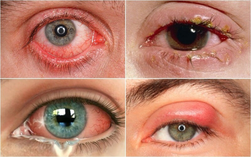 Bệnh mắt đổ ghèn xuất phát từ tình trạng viêm kết mạc