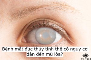Bệnh mắt đục thủy tinh thể có nguy cơ dẫn đến mù lòa?