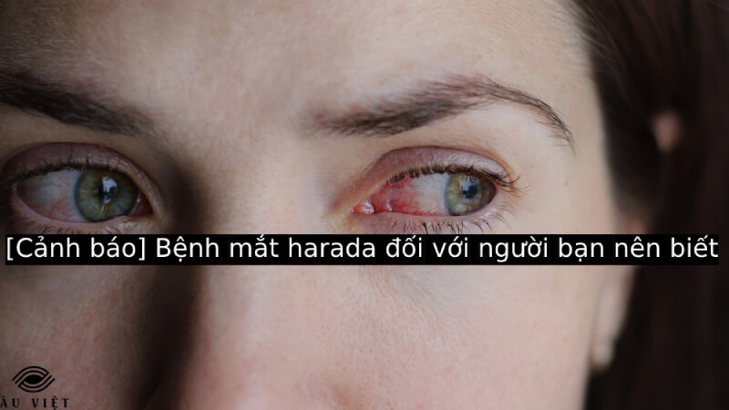 [Cảnh báo] Bệnh mắt harada đối với người bạn nên biết