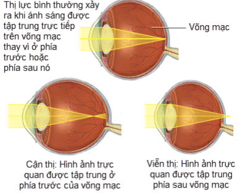 Các yếu tố dẫn đến bệnh mắt H52