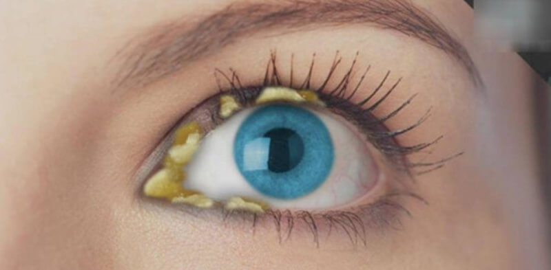 Nên đề phòng, mắt đổ ghèn có thể là triệu chứng