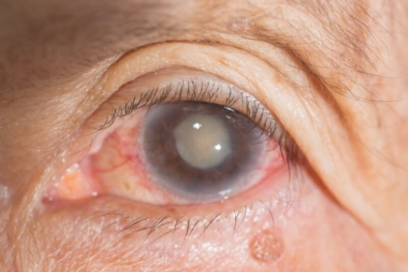 Đục thủy tinh thể ở mắt là bệnh mắt ở người già
