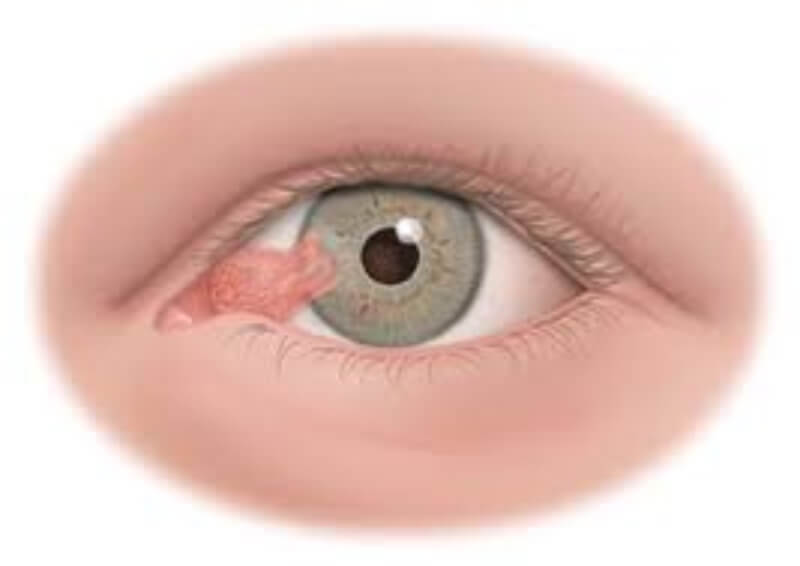 Liệu bệnh mắt đổ ghèn có thể ảnh hưởng đến thị lực