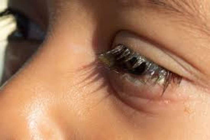 bệnh mắt đổ nghèn là gì?