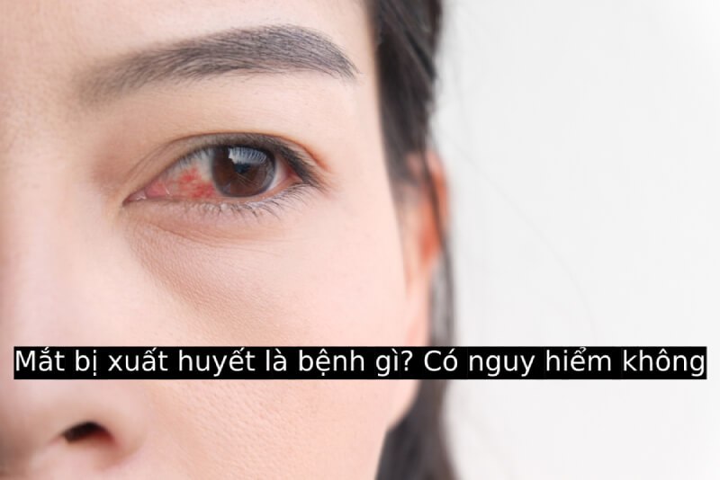 Mắt bị xuất huyết là bệnh gì? Có nguy hiểm không