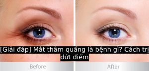 [Giải đáp] Mắt thâm quầng là bệnh gì? Cách trị dứt điểm