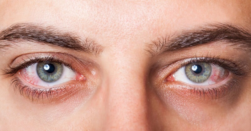 Nguyên nhân gây bệnh mắt H10