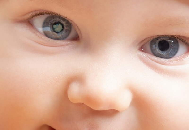 Trẻ em có nguy cơ mắc bệnh Glaucoma không?