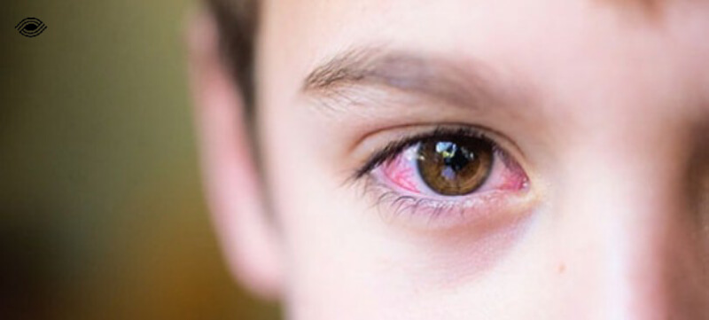 bệnh đau mắt đỏ ở trẻ em do bị dị ứng