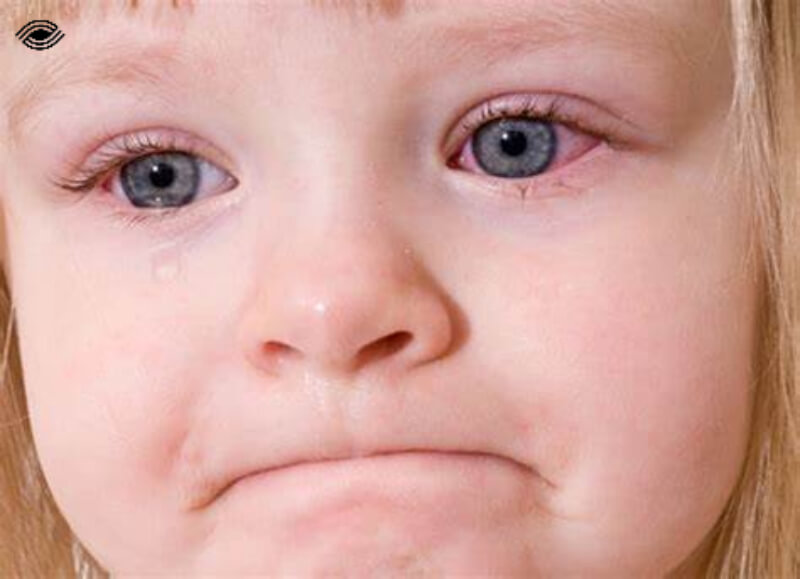 bệnh đau mắt đỏ ở trẻ em là gì