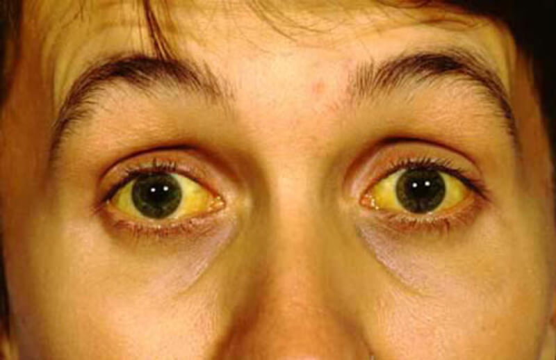 bệnh gan mắt vàng bị viêm gan