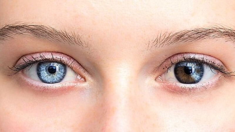 Bệnh mắt 2 màu nếu có các triệu chứng