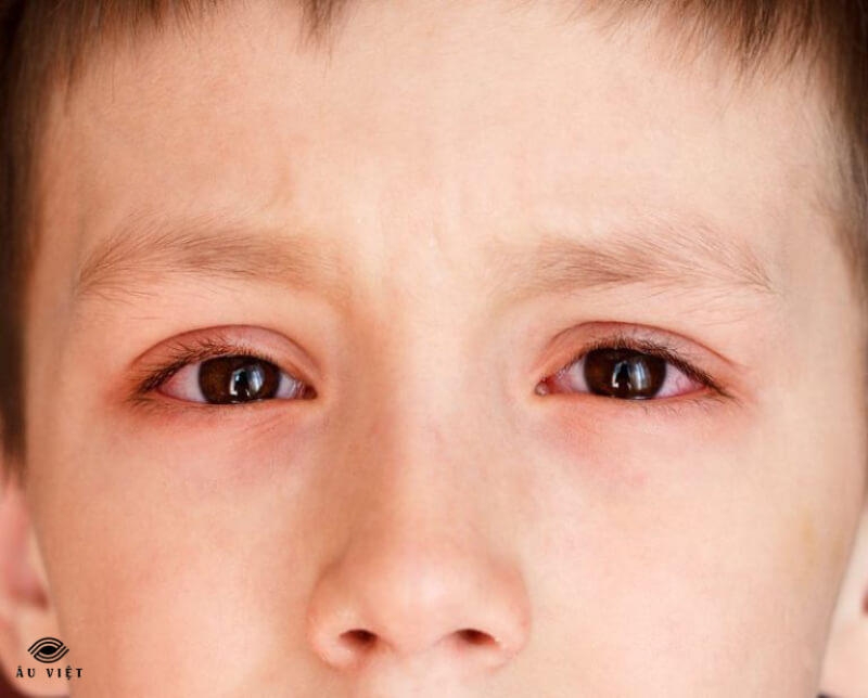 Mắt bệnh dị ứng ở mắt là gì