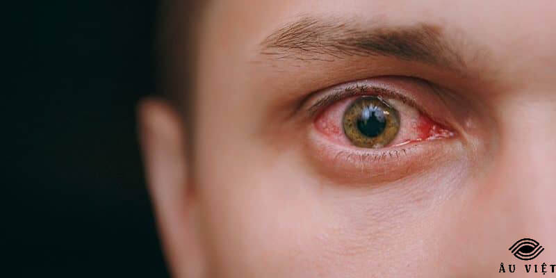 bệnh mắt harada là gì 