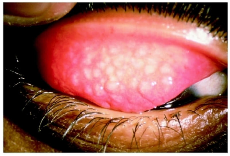  Triệu chứng rõ rệt của bệnh mắt hột