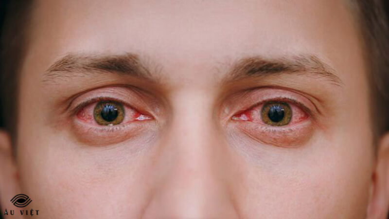 Khái niệm về bệnh mắt