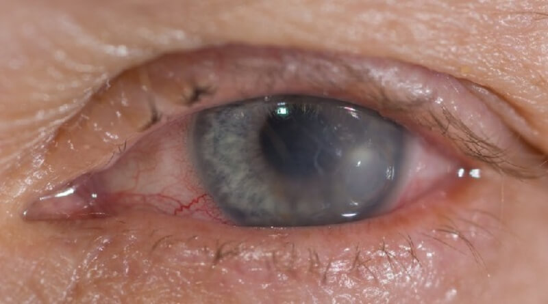 bệnh viêm loét giác mạc là bệnh mắt của người già