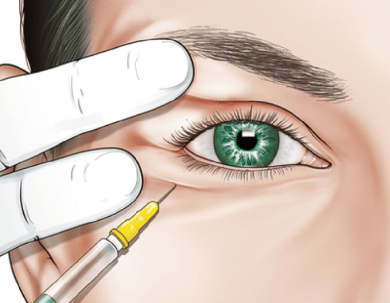 Cách điều trị bệnh mắt bồ đào