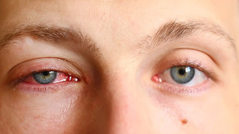 bệnh mắt đỏ và cách điều trị