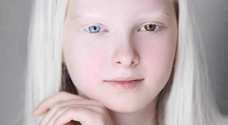 Bệnh mắt 2 màu được truyền sang cho con cái