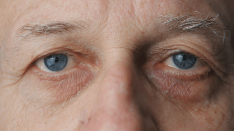 dấu hiệu bệnh khô mắt ở người lớn tuổi 