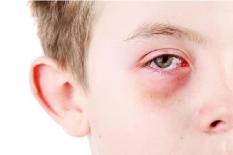 dấu hiệu và triệu chứng bệnh đau mắt đỏ ở trẻ em