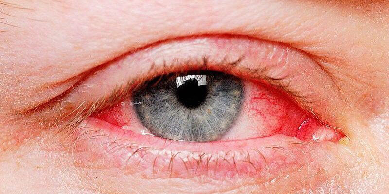 điều trị bệnh mắt H10
