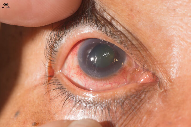 các bệnh mắt thường gặp 
