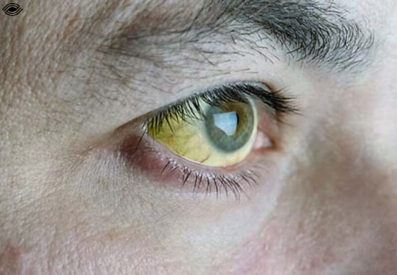 mắt vàng là bệnh gì