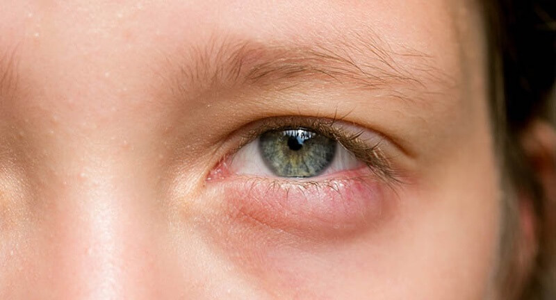 nguyên nhân bệnh chắp mắt ở trẻ em