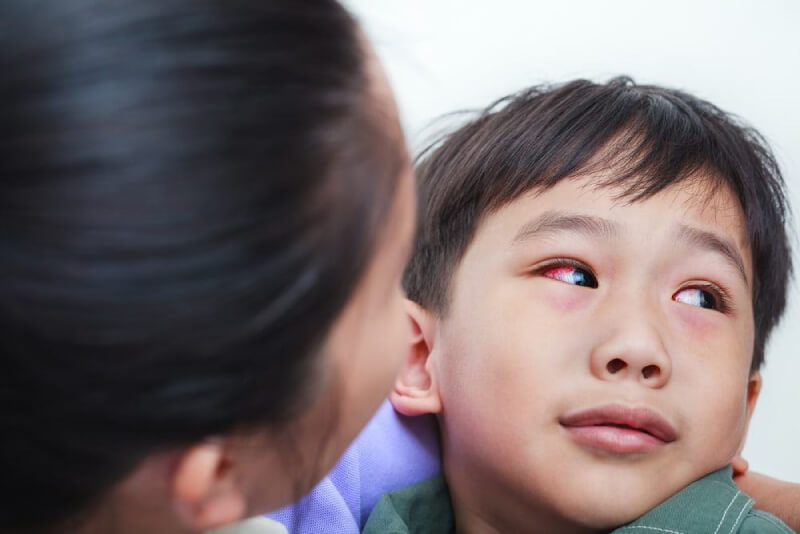 nguyên nhân bệnh mắt đỏ ở trẻ em