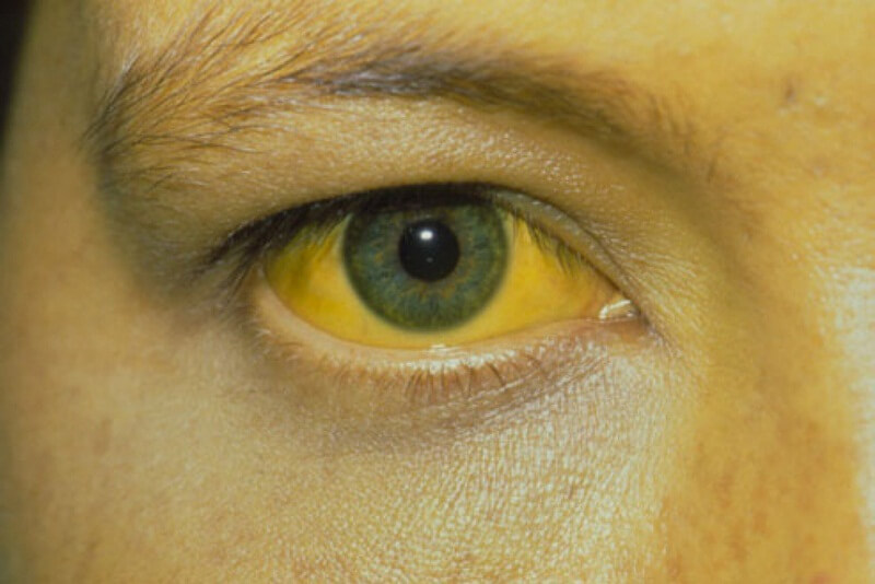 nguyên nhân bệnh mắt vàng