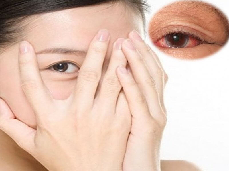 phòng ngừa được đề xuất cho bệnh mắt H10