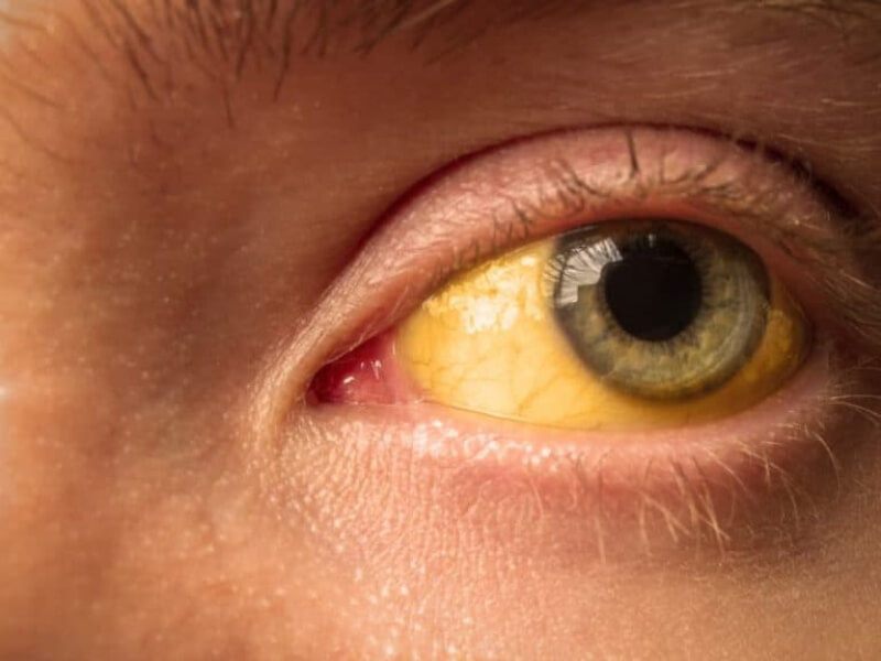 sỏi mật gây bệnh mắt vàng 