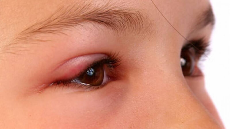 triệu chứng bệnh chắp mắt ở trẻ em
