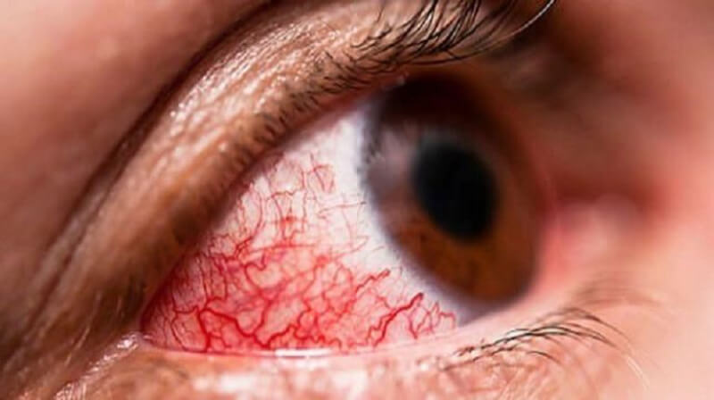 triệu chứng mắt bị xuất huyết