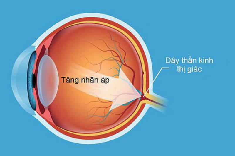 Bệnh mờ mắt là gì? có liên quan đến tăng áp trong mắt 