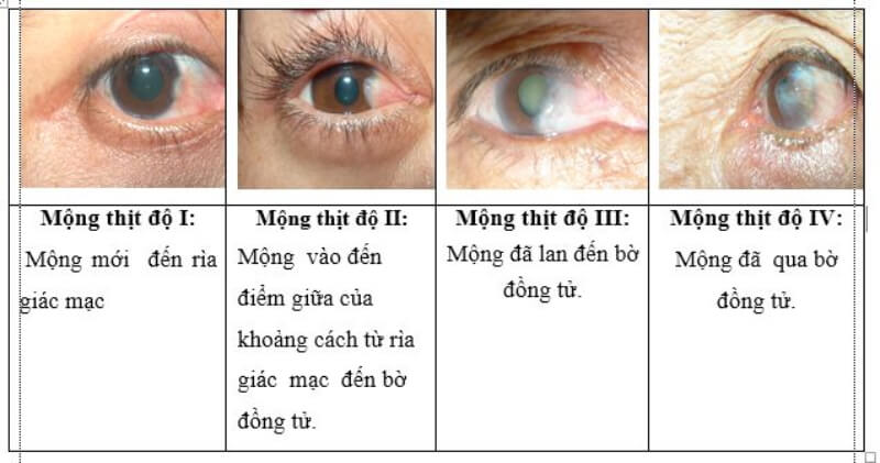 Bệnh mộng mắt gây hại cho sức khỏe