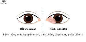 Bệnh mộng mắt: Nguyên nhân, triệu chứng và phương pháp điều trị