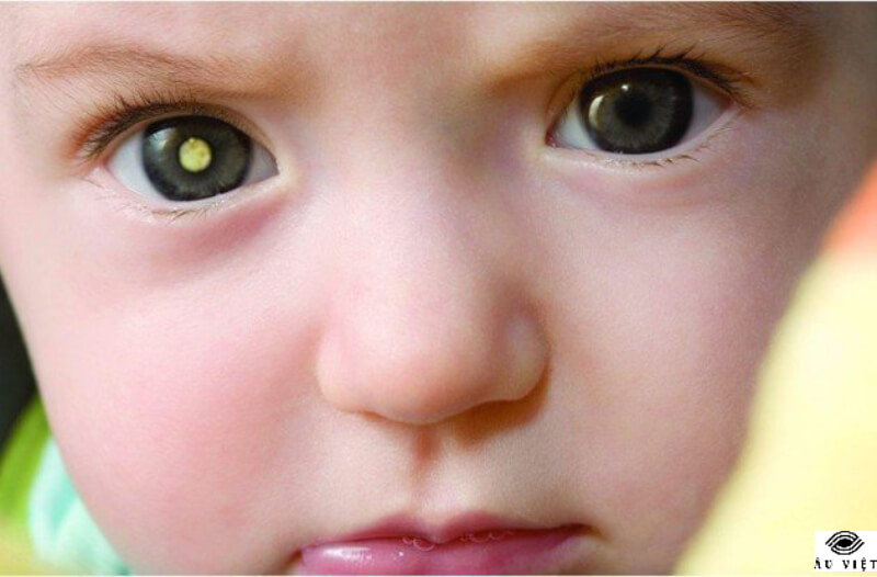 Bệnh mắt ở trẻ em - Loạn thị