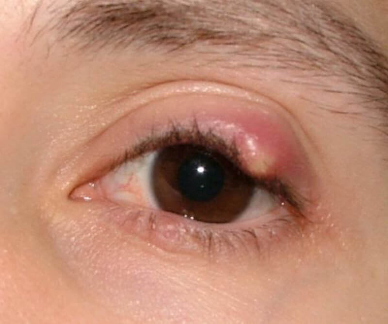 Cách chữa trị bệnh mắt lẹo