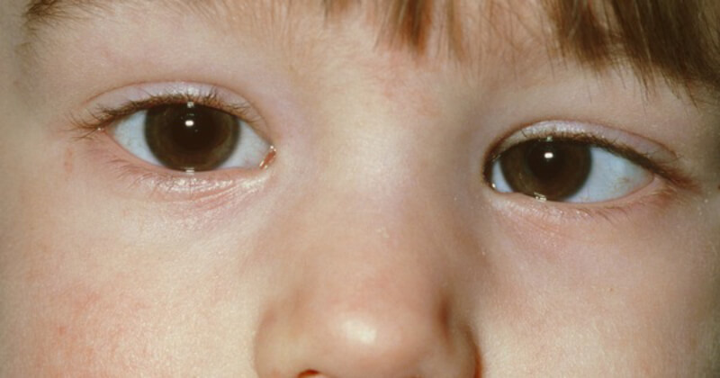 cần lưu ý gì về bệnh mắt lé